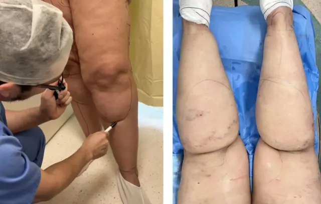 Câmara de Goiânia aprova atendimento especializado para mulheres com lipedema — imagem secundária