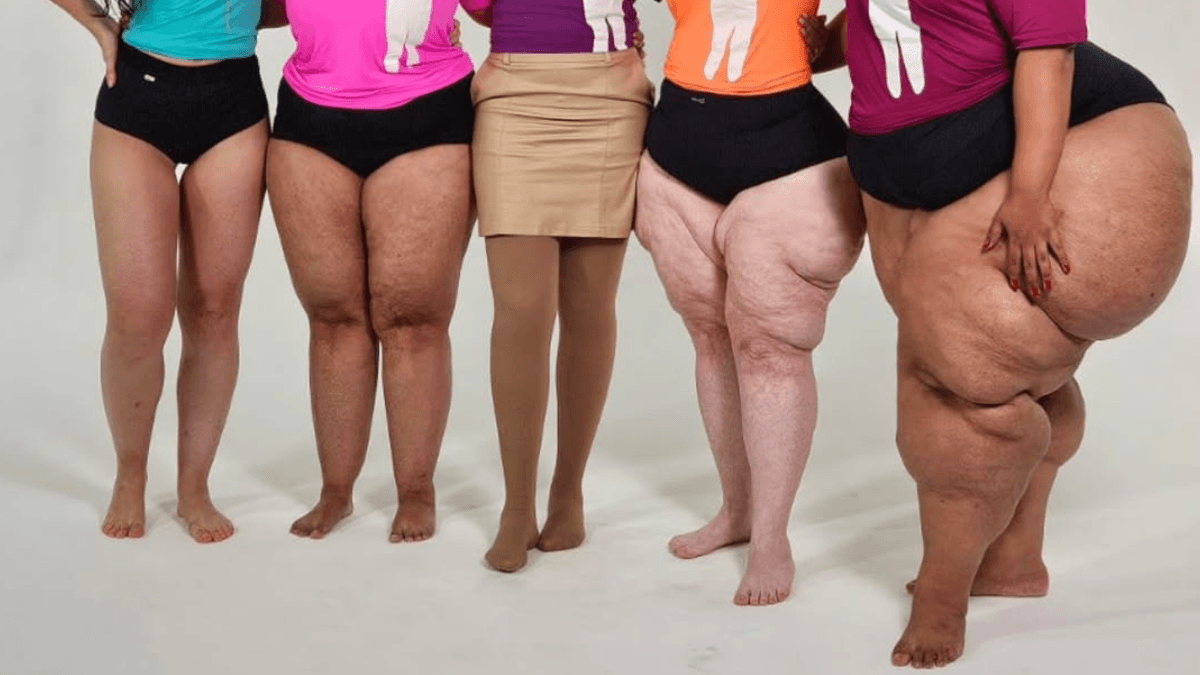 Câmara de Goiânia aprova atendimento especializado para mulheres com lipedema