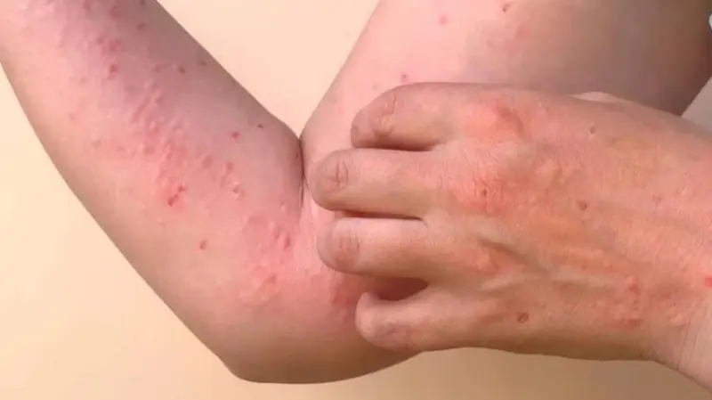 Casos de chikungunya crescem mais de 600% em Goiânia